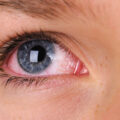 How To Cure Bacterial Pink Eye At Home Fast - No Medicine Required