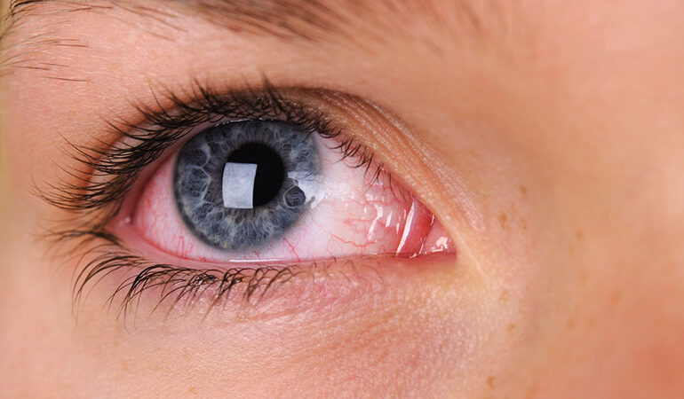 How To Cure Bacterial Pink Eye At Home Fast - No Medicine Required