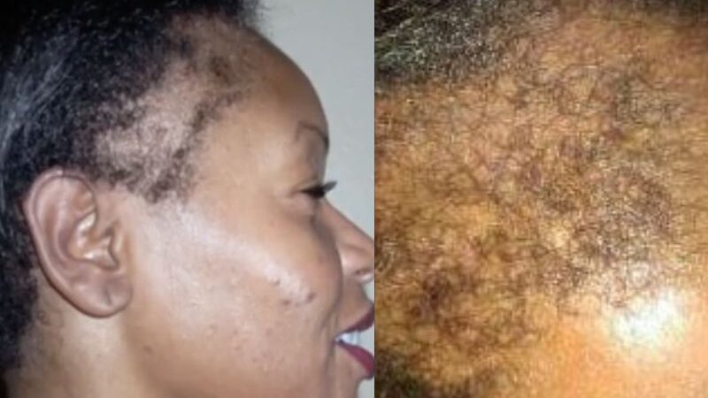 5 Hair Mistakes African Women Make That Can Damage Their Hairline