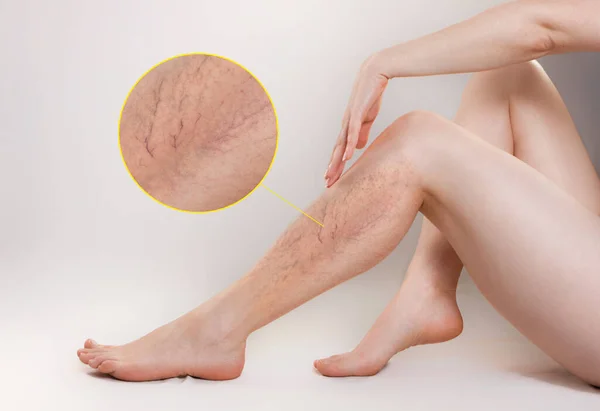 4 Simple Things Spider Veins Are Telling You About Your Health