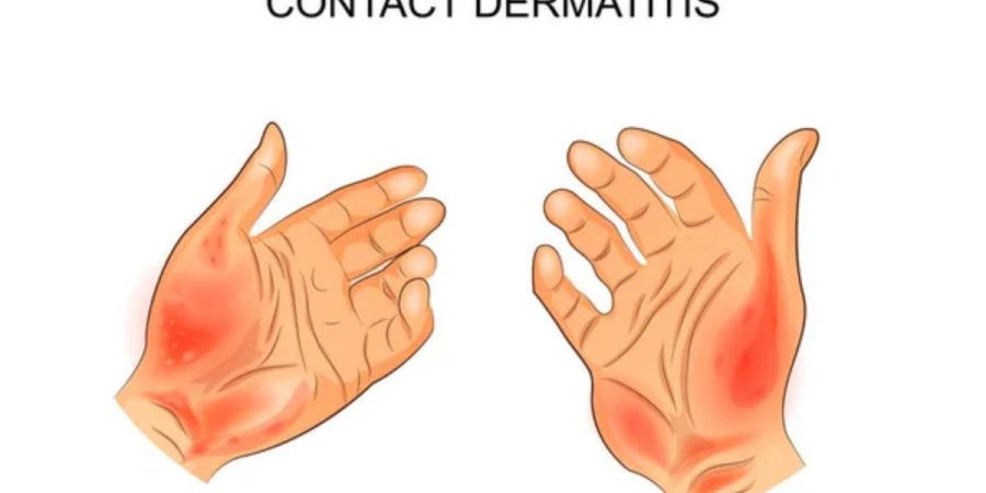 Contact Dermatitis Rash: This is Why You Frequently Have Rash