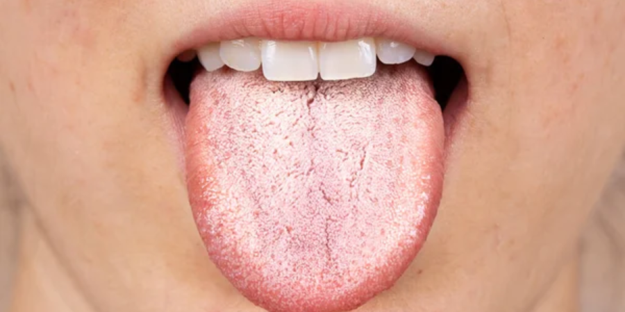 White Tongue STD: Does Having White Tongue Mean You Have STD?